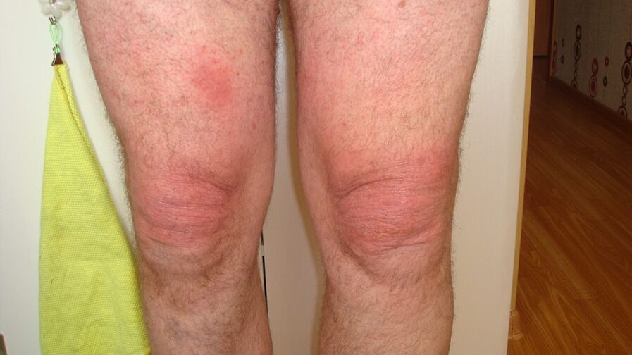 kelio sąnarių artrozė